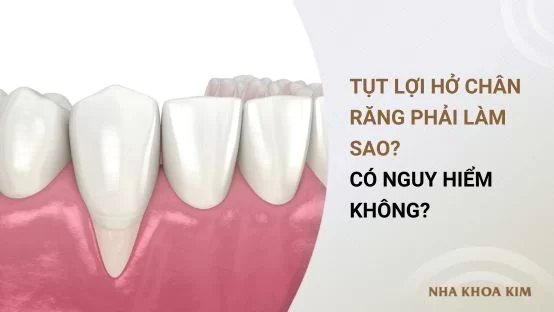 Tụt lợi hở chân răng phải làm sao? Có nguy hiểm không?